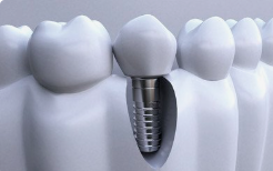 山西落地种植牙价格综合治理 单颗常规种植牙费用减半